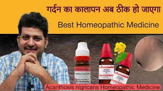 गर्दन का कालापन अब ठीक हो जाएगा  Homeopathic Medicine  Acanthosis nigricans [upl. by Bausch]