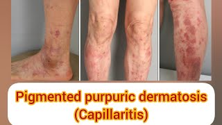 PIGMENTED PURPURIC DERMATOSIS capillaritis पैरों में काले भूरे या लाल धब्बे प्रकार कारण और उपचार [upl. by Coretta]