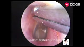 Treatment of foreign bodies cerumen and fungi on tympanic membrane surface for 11 minutes [upl. by Ban]