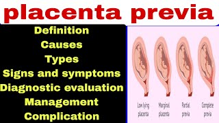 placenta previa [upl. by Sedruol]