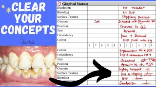 Examination Of The Gingival Status ‖ Health VS Gingival Disease ‖ Gingival Considerations ‖ PerioHub [upl. by Yednarb882]