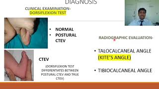 Congenital Talipes Equino Varus CTEV  Rapid Revision of Orthopaedics by Dr Prateek Joshi [upl. by Etnovaj]