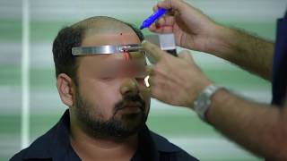 Laser hairline designing  dr Aklish Jain  Best hair transplant centre  Hair transplant in jaipur [upl. by Aikim]