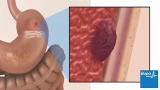 How a peptic ulcer develops  Bupa Health [upl. by Chlori]