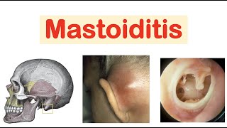 Mastoiditis amp Acute Otitis Media  Causes Pathophysiology Symptoms Diagnosis Treatment [upl. by Terra]