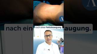 fettabsaugung fettabbau fettabnehmen plastischechirurgie düsseldorf [upl. by Alvord]