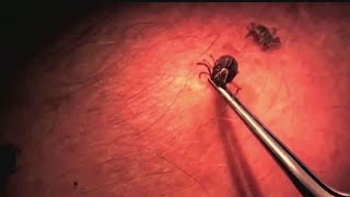 How to prevent and treat tick bites [upl. by Issor717]