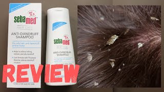 Best Dandruff Shampoo  Shampoo for seborrheic dermatitis  how to treat and control dandruff [upl. by Giannini682]