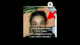 Left abducens nerve  CN 6  palsy [upl. by Etselec705]