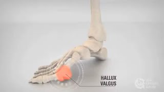 Hallux Valgus [upl. by Bibeau]