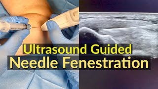 Ultrasound Guided Needle Fenestration  Dry Needling for Tennis Elbow [upl. by Martica]