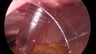 Laparoscopic Sleeve Gastrectomy [upl. by Adnov]