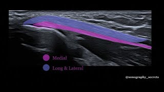 Triceps rupture ultrasound [upl. by Nial]