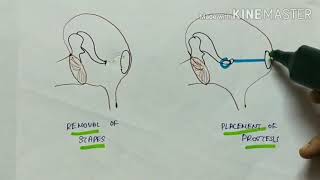 otosclerosis  ENT  etiology  pathophysiology  clinical manifestations  treatment  English [upl. by Leon]