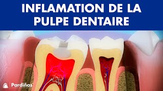 Pulpite – Inflamation de la pulpe dentaire © [upl. by Cornell]