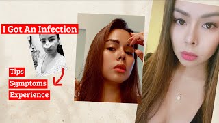 I GOT AN INFECTION  NOSE JOB INFECTION AFTER 5 MONTHS [upl. by Venable]