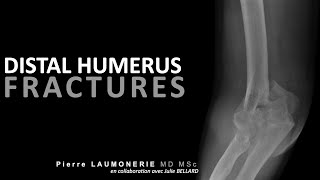 Fractures de la palette humérale  fracture of the distal humerus [upl. by Khajeh]