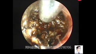 Earwax Removal ExtractionThe first case of giant external auditory meatus cholesteatoma in 2018 [upl. by Eppes]