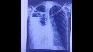 xray lungs Hydropneumothorax pleura effusionpneumothorax [upl. by Atirehs]