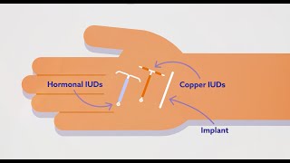 IUDs for Contraception [upl. by Melitta466]