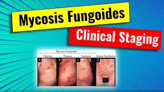 Staging of Mycosis fungoides MF  video series for dermatology residency and USMLE [upl. by Landbert]