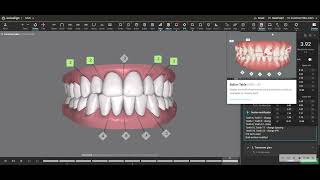 What is a Bolton Discrepancy and how does it relate to IPR Interproximal reduction [upl. by Asaph]