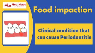 Food impaction  A cause for periodontitis  Caries  gum problem Mediklaas [upl. by Enoved]