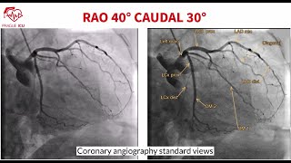 Coronary angiography standard views [upl. by Scherle561]