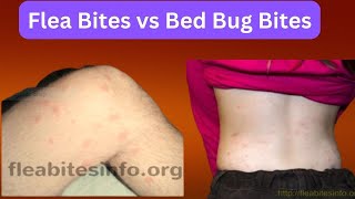 Bed bug bites vs flea bites [upl. by Ceporah654]