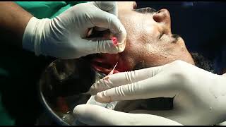 Arthrocentesis Procedure TMJ [upl. by Eadahc]