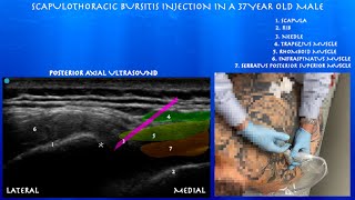 Ultrasound Guided Scapulothoracic Bursa Injection by probeultrasound [upl. by Retsel397]