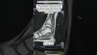 MRI Ankle Showing tenosynovitis in t1tsesag Sequence beginners [upl. by Jesher]