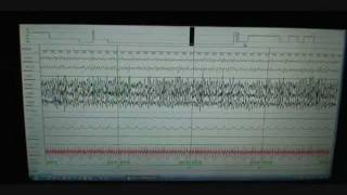 Sleep Study Scoring on Person with Normal Sleep Polysomnograph [upl. by Meriel]