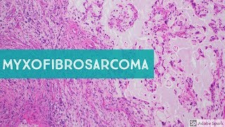 Myxofibrosarcoma 101Explained by a Sarcoma Pathologist [upl. by Eves479]