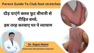 How to do Clubfoot Stretches  Clubfoot exercises  क्लबफूट के व्यायाम  टेड़े मेड़ें पाँव की कसरत [upl. by Ameg]