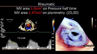 In Mitral Stenosis disparity between various methods to assess MV area [upl. by Adekan]