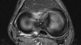 Fibular collateral ligament sprain and meniscus fascicle tear [upl. by Aicener]