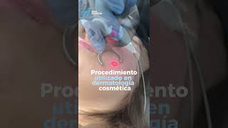 Tratamiento para cicatrices de acné con láser Co2  Skin Hospital  acne [upl. by Verger]