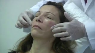 Painless Sculptra Part II  Dr Tanveer Janjua  New Jersey [upl. by Kaazi]