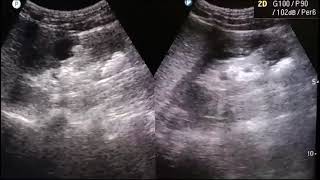 KIDNEY STONES  show multiple calculi  ultrasound usg stone kidney calculi [upl. by Eednak]