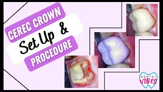 CEREC CROWN PREP SET UP amp PROCEDURE  Dental Assistant Tips [upl. by Naerad]