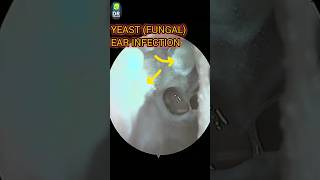 YEAST FUNGAL in earSPECIAL CASEshorts by Dr ABHINAV [upl. by Nal153]