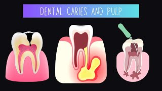 Dental caries and pulp [upl. by Colbye]