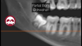 Mesioangular Wisdom Tooth Extraction Step by Step [upl. by Hajile]