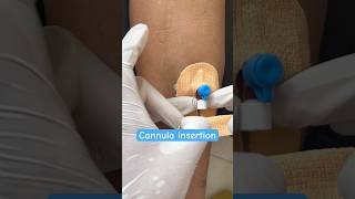 Cannula insertion of male patient nurses cannula shorts neet ytshorts youtubeshorts subscribe [upl. by Eruza]