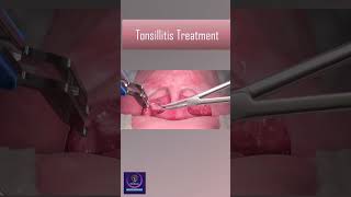 Tonsillitis Treatment With Heat Device tonsillitis [upl. by Lraep912]