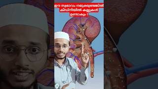 Kidney stone formation Dr Muhammed Shibili healthtips [upl. by Ettedualc]