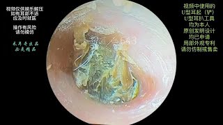 采耳哥Clean the ear canal blocked by fungal dry patches ｜643 [upl. by Arita765]