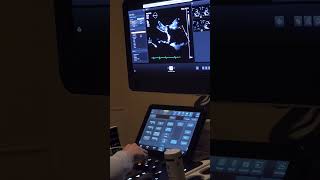 Heart Echo Ultrasound echocardiogram in Progress 120823 [upl. by Talbert]