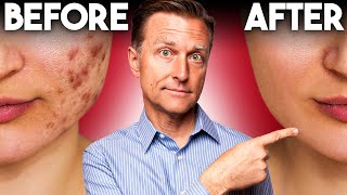 The FASTEST Way to Rid Acne  Dr Berg [upl. by Notlew]